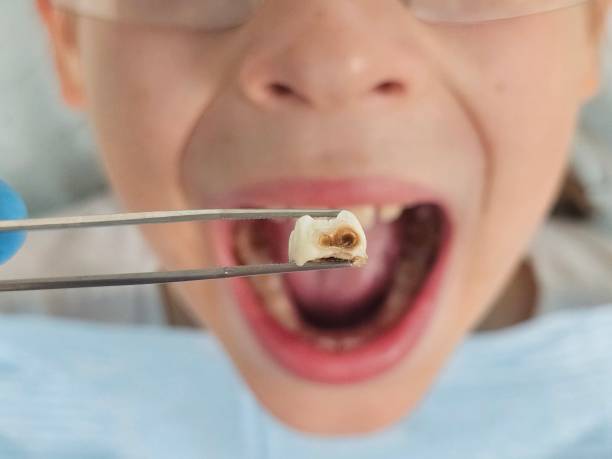 Best Chipped Tooth Repair Near Me  in Seminole Manor, FL